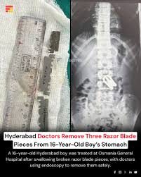 Osmania General Hospital doctors remove blade from minor’s body