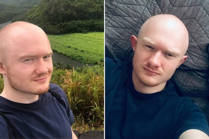Gen Z Men Are Going Bald Early. Start-Ups See A Billion-Dollar Opportunity